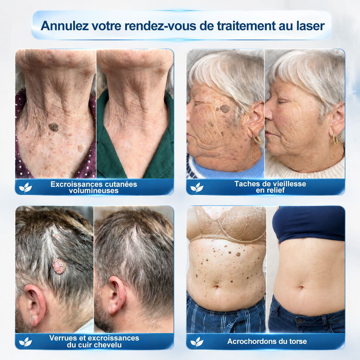 Boutique officielle de la marque 🔊 𝐏i𝐜𝐝o® 7 Jours Effaceur de taches et d’excroissances cutanées(Zéro douleur, zéro cicatrice – Roller)
