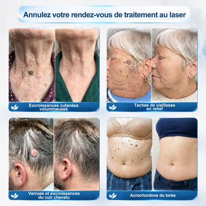 Boutique officielle de la marque 🔊 𝐏i𝐜𝐝o® 7 Jours Effaceur de taches et d’excroissances cutanées(Zéro douleur, zéro cicatrice – Roller)