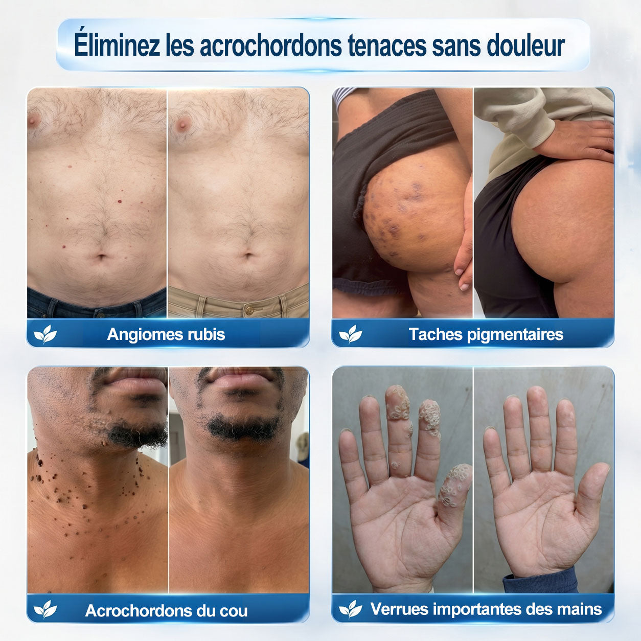 Boutique officielle de la marque 🔊 𝐏i𝐜𝐝o® 7 Jours Effaceur de taches et d’excroissances cutanées(Zéro douleur, zéro cicatrice – Roller)