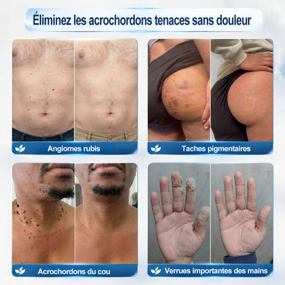 Boutique officielle de la marque 🔊 𝐏i𝐜𝐝o® 7 Jours Effaceur de taches et d’excroissances cutanées(Zéro douleur, zéro cicatrice – Roller)