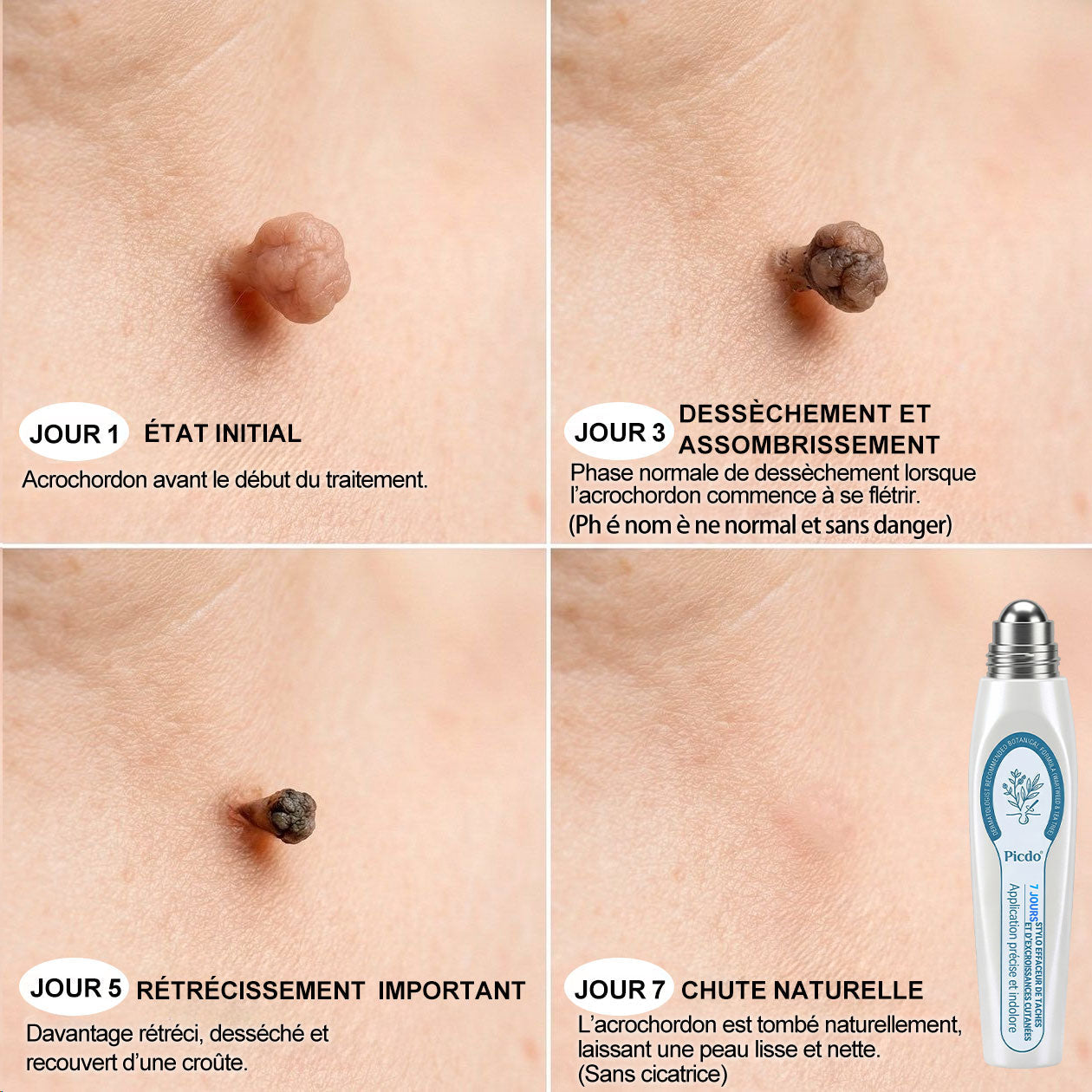 Boutique officielle de la marque 🔊 𝐏i𝐜𝐝o® 7 Jours Effaceur de taches et d’excroissances cutanées(Zéro douleur, zéro cicatrice – Roller)